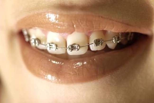 Can I do teeth whitening when having braces