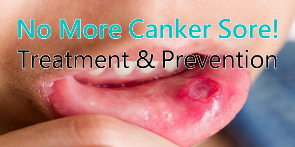 Canker Sore Treatment 2