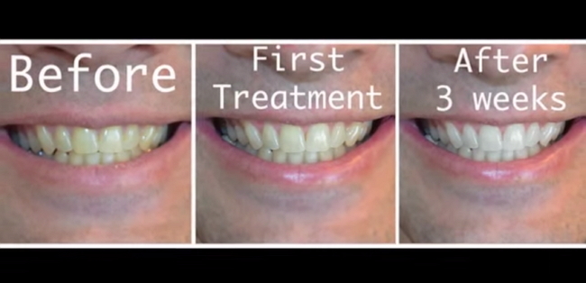 Teeth whitening with hydrogen peroxide