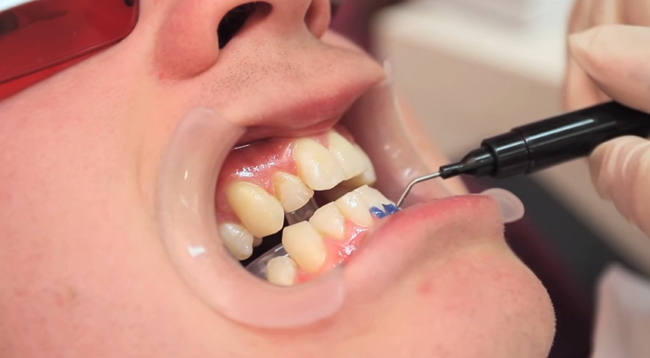 Teeth whitening with laser