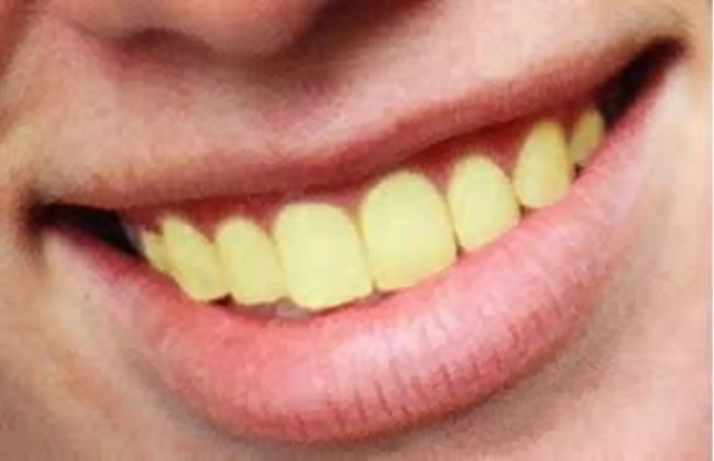 smilebox teeth whitening reviews