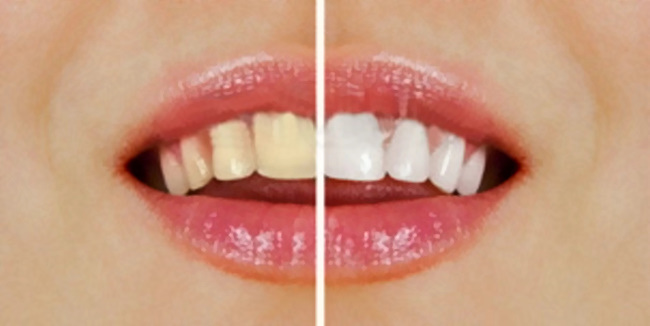 Treatment after teeth whitening