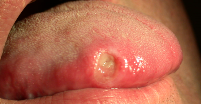 What Caused Mouth Ulcer 1